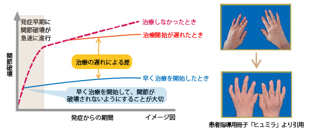 関節破壊の進み方と治療効果